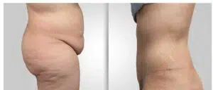 chirurgie esthetique tunisie avant apres