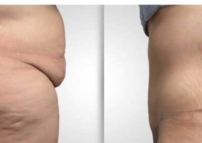 chirurgie esthetique tunisie avant apres