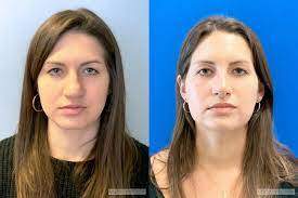 Rhinoplastie tunisie prix