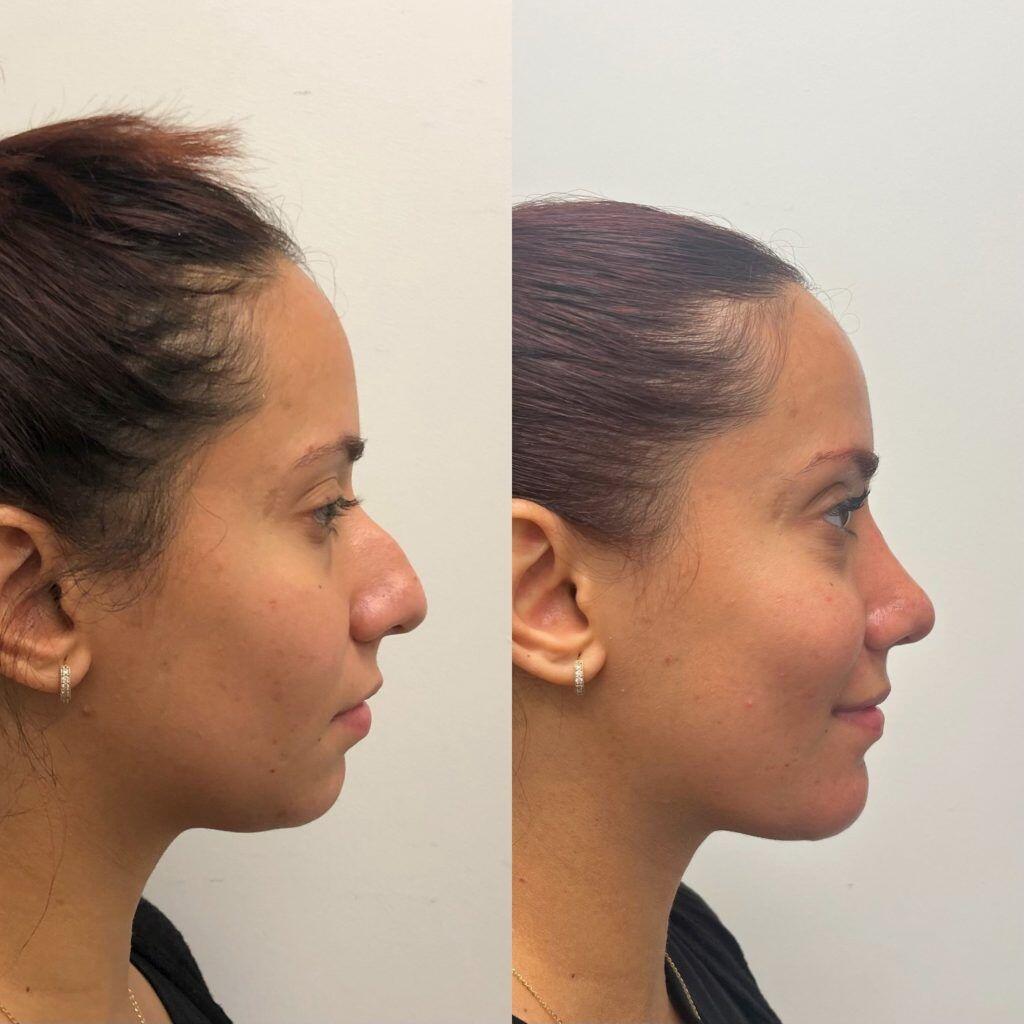 cout rhinoplastie tunisie