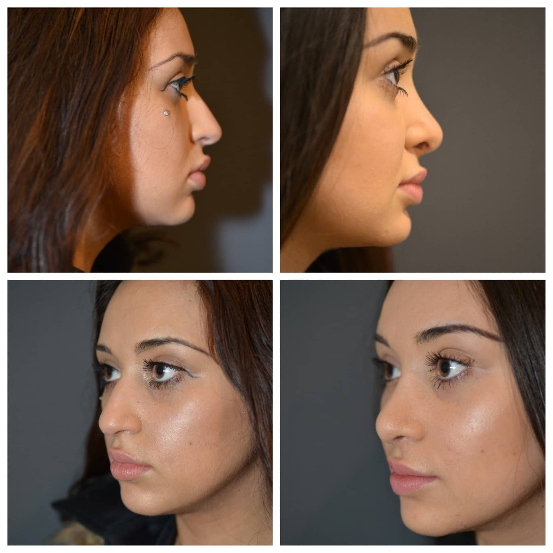 cout rhinoplastie tunisie