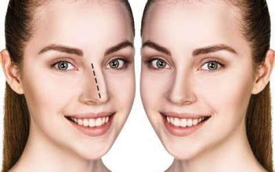 La Rhinoplastie en Tunisie : Un Monde de Possibilités !