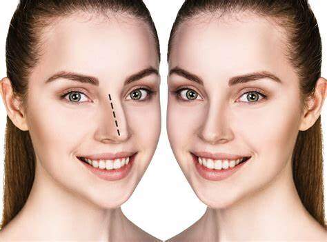 La Rhinoplastie en Tunisie : Un Monde de Possibilités !