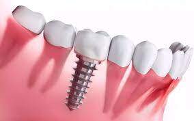 implants dentaire tunisie