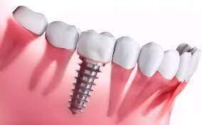 Implants dentaire tunisie prix