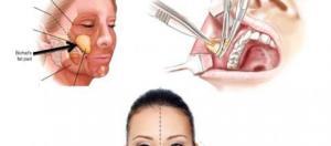Buccal Fat Removal surgery