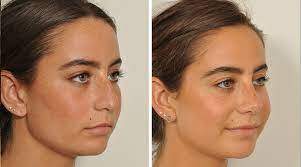 rhinoplastie tunisie tarif