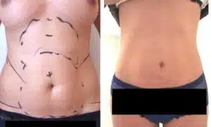 chirurgie esthetique tunisie avant apres
