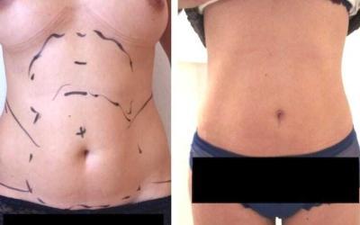 Chirurgie esthetique tunisie avant apres