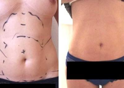 chirurgie esthetique tunisie avant apres liposculpture