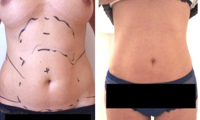 chirurgie esthetique tunisie avant apres liposculpture