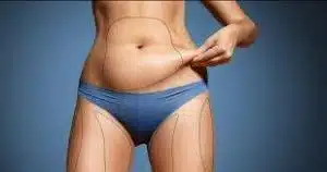 Liposuccion ventre prix