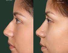 Rhinoplastie tunisie prix, La rhinoplastie est-elle nécessaire après une fracture du nez