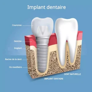 implants dentaire tunisie prix