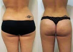 chirurgie esthetique tunisie avant apres