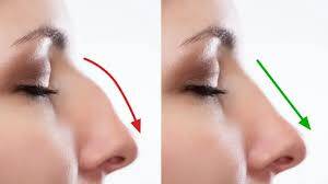 Rhinoplastie tunisie prix, rhinoplastie sans chirurgie