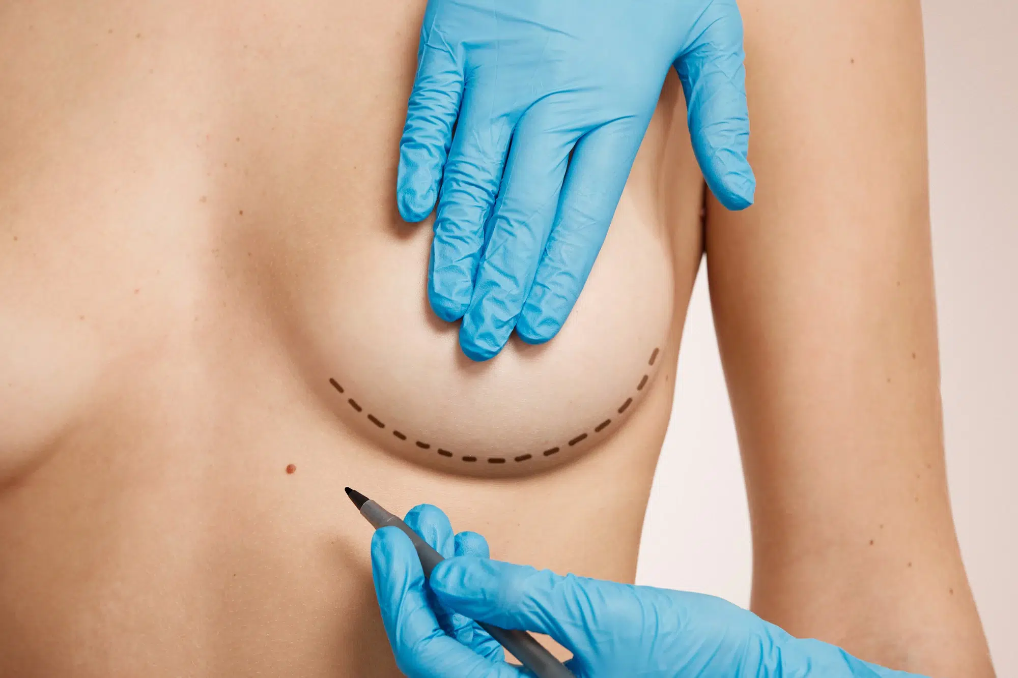 breast augmentation surgery in Tunisia, Changement de prothèses mammaires
