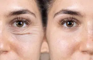 Avant après blepharoplastie