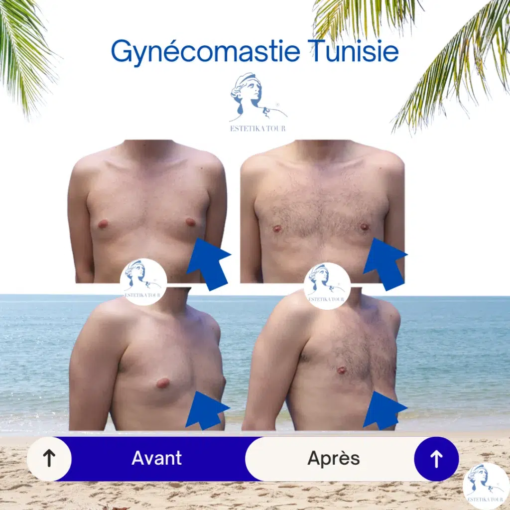 Gynécomastie tunisie