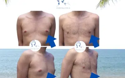 Gynecomastie tunisie Gynécomastie