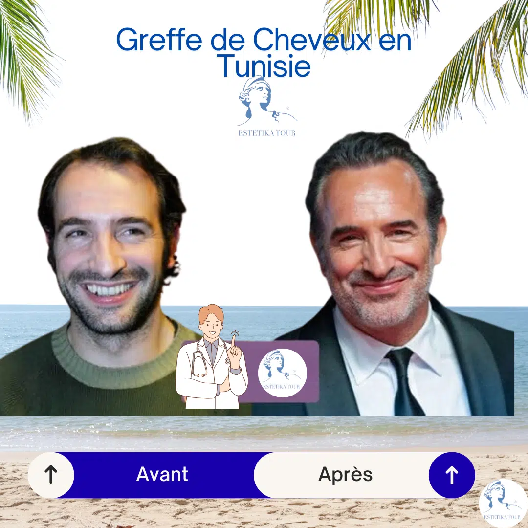 greffe de cheveux tunisie prix