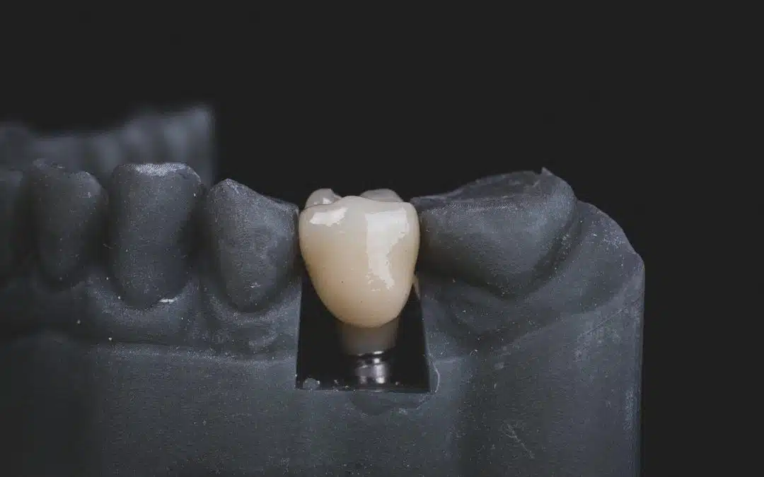 Implant dentaire douleur