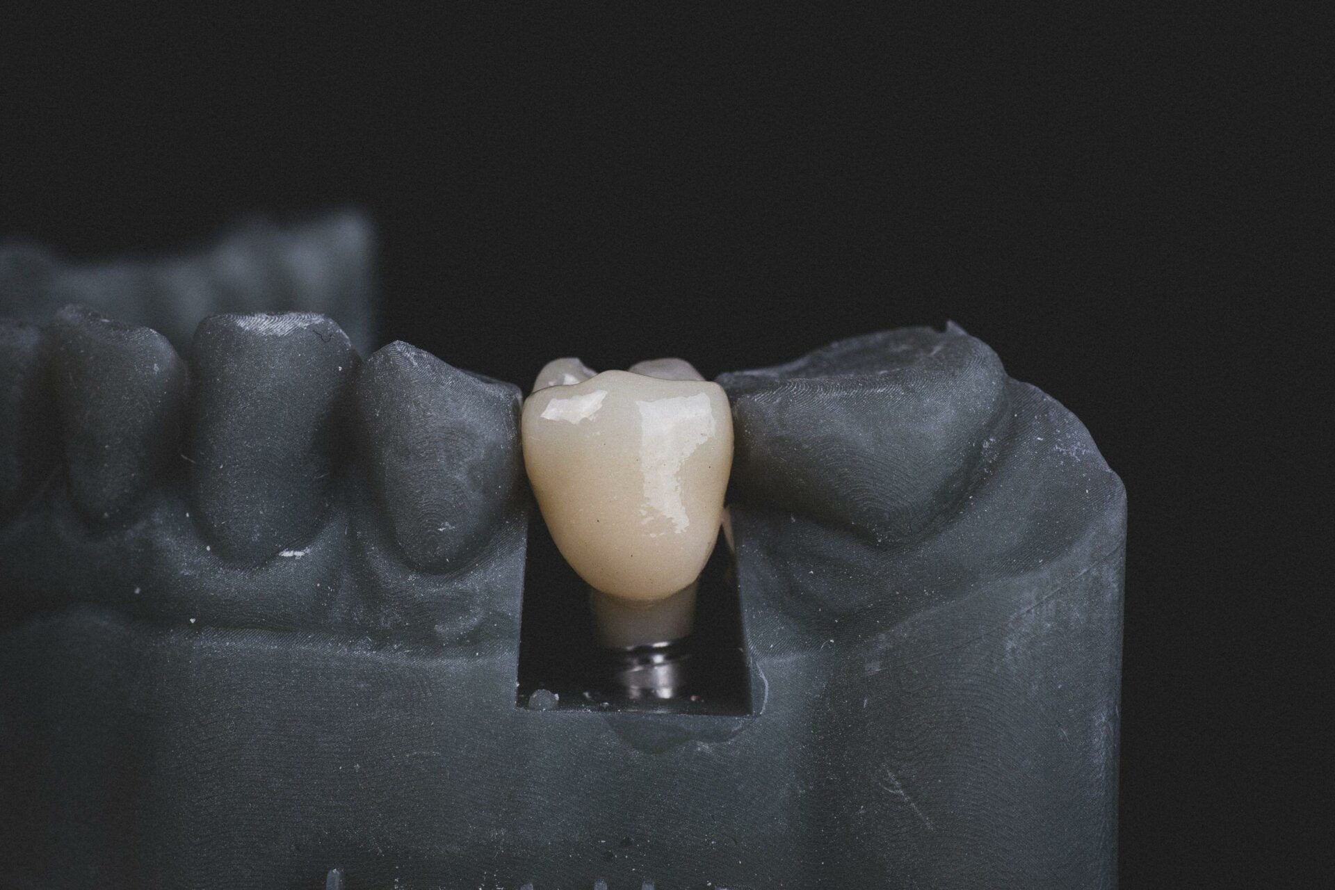 implants dentaire