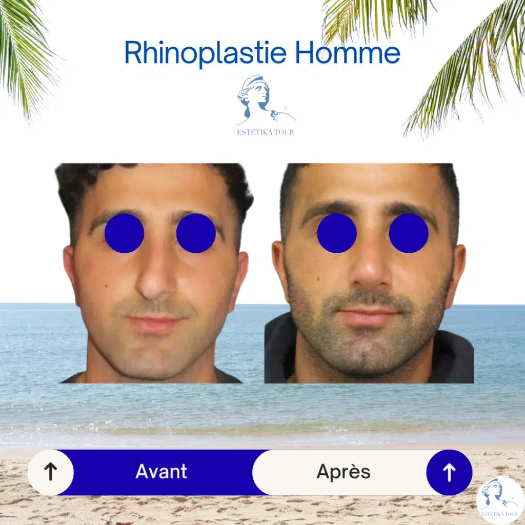 rhinoplastie homme