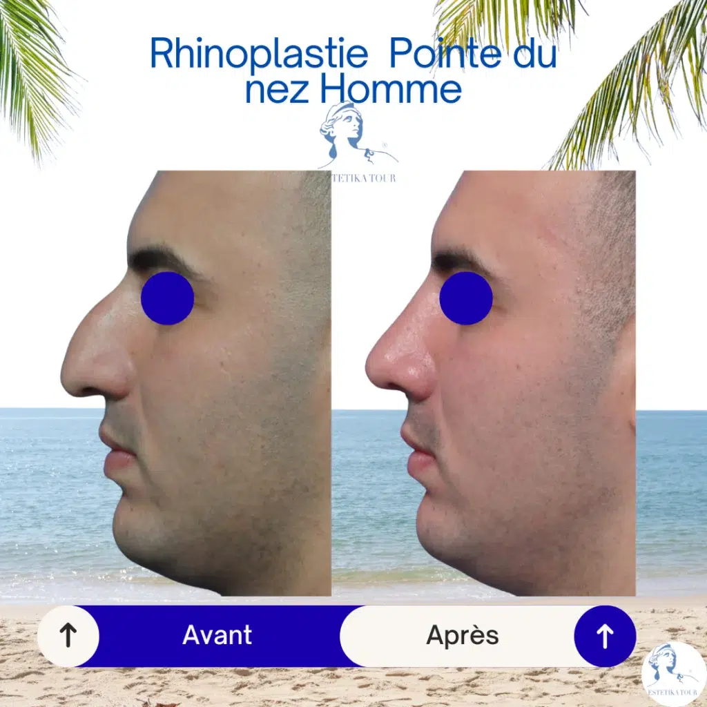 rhinoplastie homme