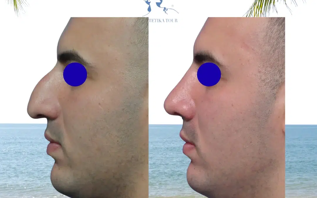 Rhinoplastie homme