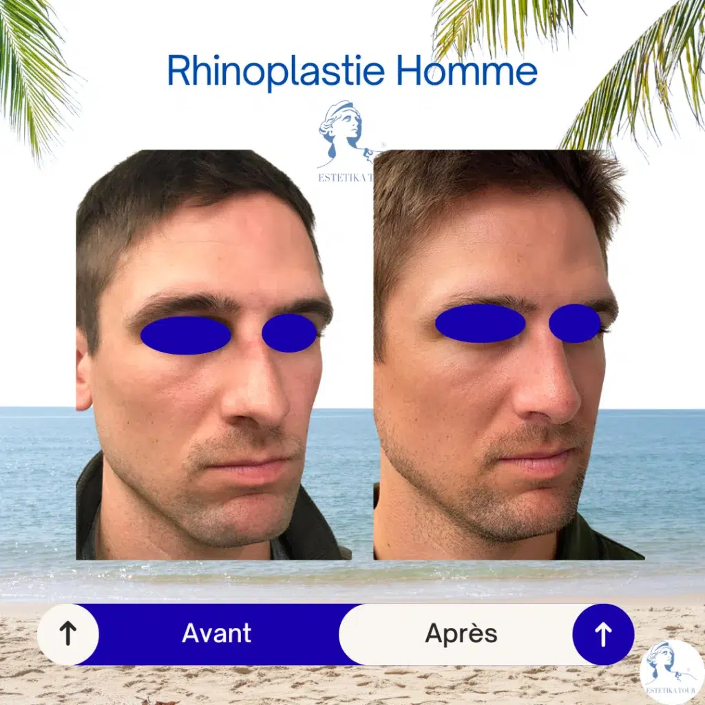 rhinoplastie homme prix