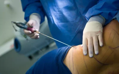 Liposuccion ventre prix tunisie