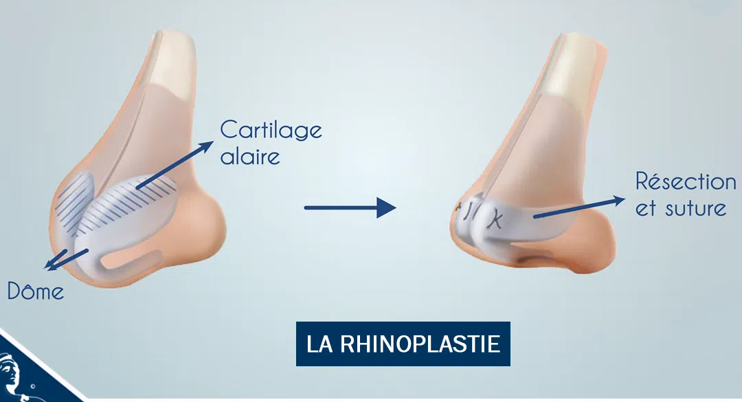 prix refaire son nez tunisie, Chirurgie esthétique nez