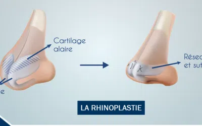 34534685 10155735074102833 3303814471876608000 o e1675934786569 Chirurgie esthétique nez