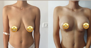 Prix Augmentation Mammaire Tunisie estetika Tour, chirurgie esthétique des seins