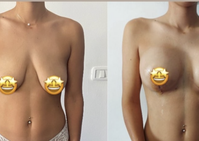 Prix Augmentation Mammaire Tunisie estetika Tour, chirurgie esthétique des seins