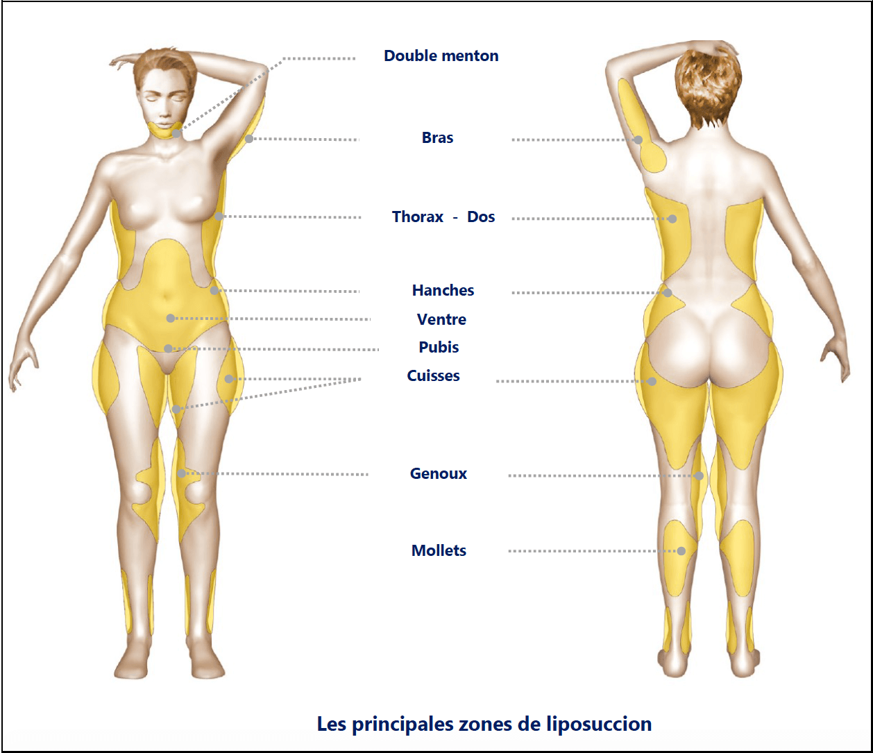 liposuccion ventre prix