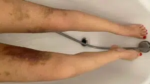 Liposuccion cuisse ratée france