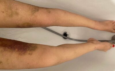 Liposuccion cuisse ratée