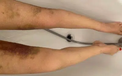 Liposuccion cuisse ratee Liposuccion cuisse ratée