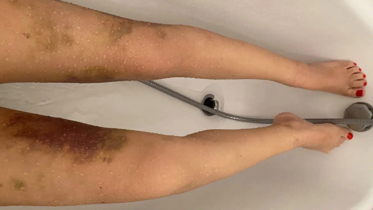 Liposuccion cuisse ratée france