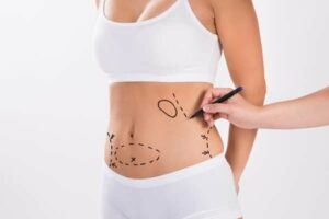 abdominoplastie