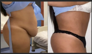 Bienfaits médicaux de l'abdominoplastie