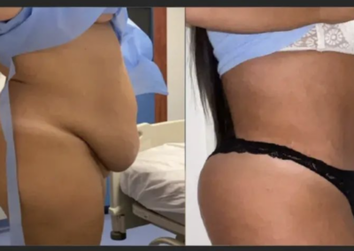 Bienfaits médicaux de l'abdominoplastie