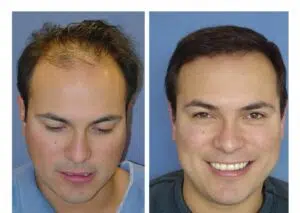 apres une greffe de cheveux tunisie e1677620239180
