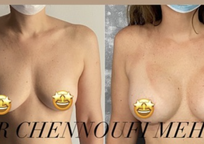 Prix Augmentation Mammaire Tunisie, chirurgie esthétique des seins