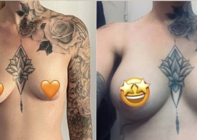 Prix Augmentation Mammaire Tunisie, chirurgie esthétique des seins