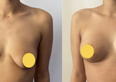augmentation mammaire tunisie estetika tour chirurgie esthétique avant après, chirurgie esthétique des seins Prix Augmentation Mammaire Tunisie