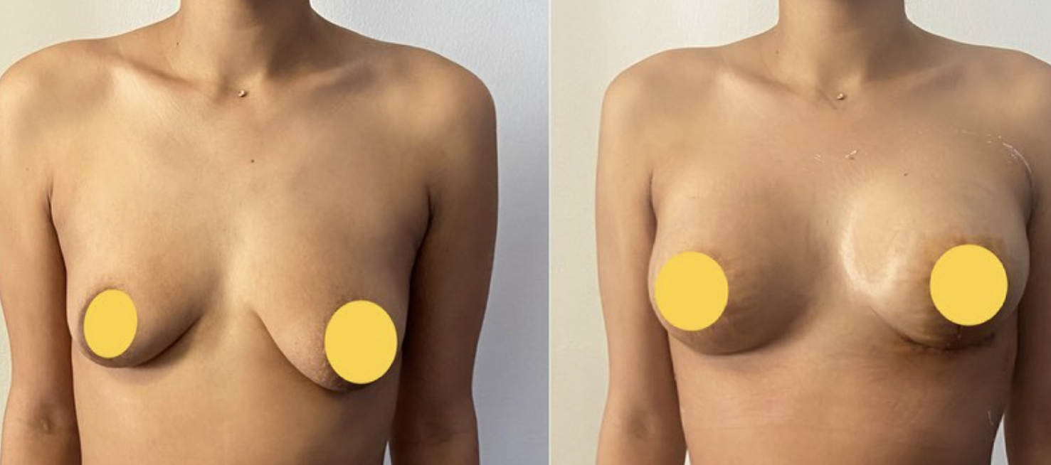 augmentation mammaire tunisie estetika tour chirurgie esthétique avant après