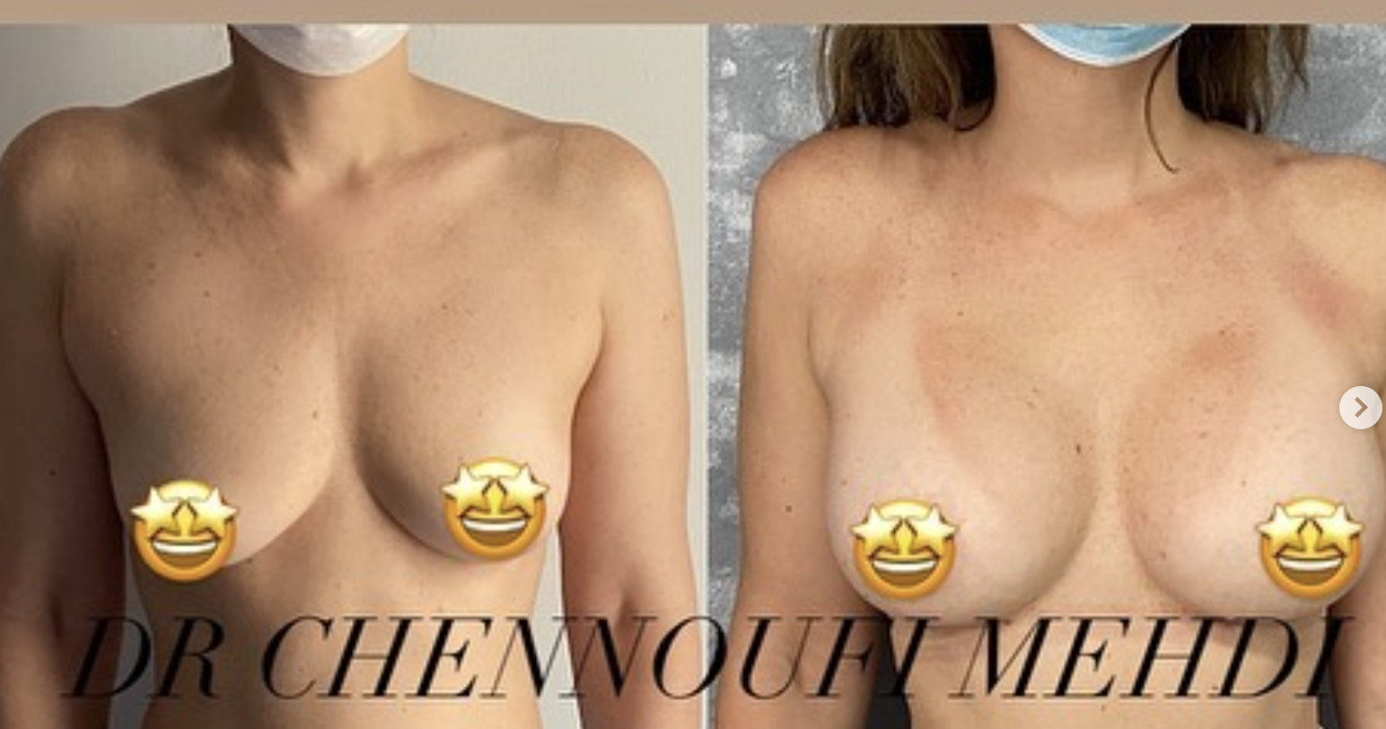 Prix Augmentation Mammaire Tunisie, chirurgie esthétique des seins